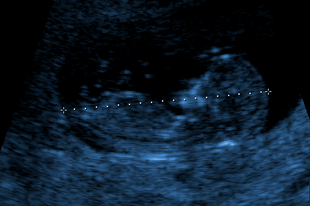 Фото Узи Эмбриона По Неделям Беременности