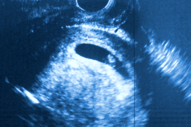 Плод сроком 4 недели. Плодное яйцо на УЗИ 4 недели от зачатия. УЗИ 4 недели беременности от зачатия фото плода. Шестая неделя беременности от зачатия УЗИ. 4 Эмбриональная неделя УЗИ.